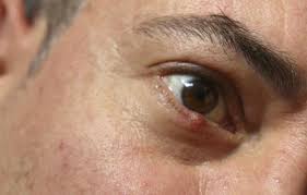 Reprezentanții celei mai frumoase jumătăți a omenirii se pot îngrijora de insuficiența sau supraponderali, de forma unghiilor sau a părului. Mic Cos Alb Pe Ochi Puncte Albe Sub Ochi Cauze Ale ApariÈ›iei È™i Metode De LuptÄƒ