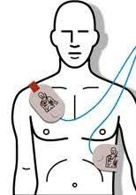 Effective defibrillation requires defibrillation of 95% of the cardiac muscle. Basic Life Support Vic First Aid