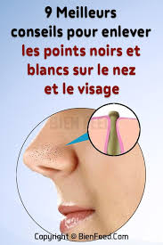 9 Meilleurs Conseils Pour Enlever Les Points Noirs Et Blancs Sur Le Nez Et Le Visage Point Noir Points Noirs Et Blancs Visage