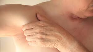 Image result for Intertrigo