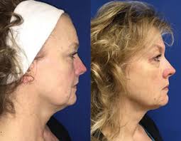 Top Mini Facelift Doctors in Ann Arbor, MI