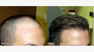 The final appearance from the hair transplant is appreciated at this point. Fue Hair Transplant What To Expect Cost Pictures And More