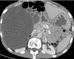 We did not find results for: Laparoscopic Treatment Of Retroperitoneal Cystic Mesothelioma Two Cases Reported Sciencedirect