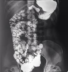 Image result for Intestinal Malrotation