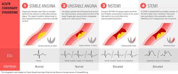 The pain may be associated with dyspnea, nausea or vomiting, syncope, fatigue, or diaphoresis. Grepmed On Twitter Acute Coronary Syndrome Ua Vs Nstemi Vs Stemi By Sneathpaula Leahzhao Richardarmour99 Via Wearecanadiem Sirens To Scrubs Series Https T Co Aku1dkhhdi Foamed Foamim Images Made Searchable On Https T Co Q0m3u6n5pp Acs