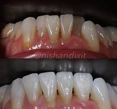 How long does invisalign take to work? How Long Does Invisalign Take Blue Court Dental Centre Harrow