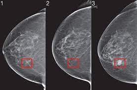 What does cancer look like on a mammogram. Robust Artificial Intelligence Tools To Predict Future Cancer Mit News Massachusetts Institute Of Technology