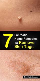 How do i get rid of skin tags at home? 7 Fantastic Home Remedies To Remove Skin Tags