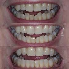 Kissdental is your trusted dentists in manchester that offers dental treatments including teeth implants, crowns, and cosmetic dentistry. 19 Inman Aligner Ideas Inman Aligner Inman Orthodontics