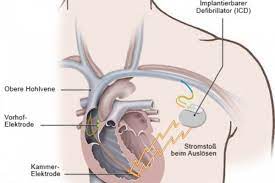 The heart has it's own electrical system that regulates the heartbeat. Defibrillator