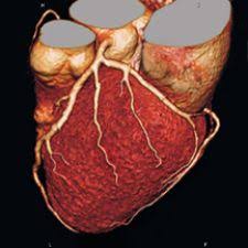 128 Slice Sets Bar For Triple Rule Out Imaging Technology News