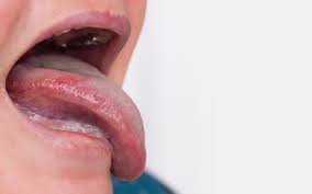 Image result for lichen planus on tongue)