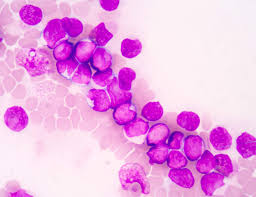 Image result for Acute Leukemia