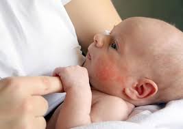 Bebeklerde Alerji Bebeklerde Alerji Belirtileri Lansinoh