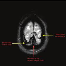 The most frequent and often early symptom of thrombosis of cerebral veins and sinuses is a headache. Magnetic Resonance Venography Mrv Of The Brain Showing Extensive Download Scientific Diagram