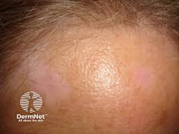 Image result for red rash face