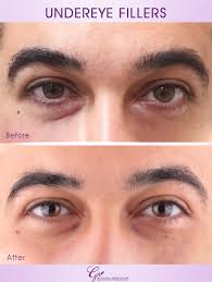 Have your youthful look by eye lift procedures at Glow clinics. Ask for  surgical eye lift surgery or non-surgical (plasmage