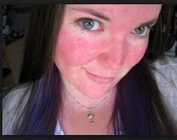 Check spelling or type a new query. Red Cheeks Bumps Pimples Sensitive Skin Could Be Rosacea Parkside Obgyn Medical Spa
