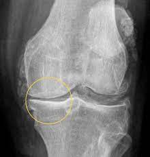 Kniearthrose Gelenkerhalt Bei Arthrose Im Knie Gelenk Klinik De