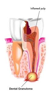 Image result for granuloma gum disease