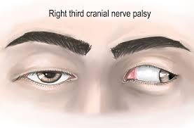 Image result for Pupillary Paralysis