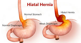Image result for stomach hernia symptoms