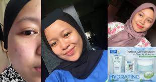 Ramainya yg taktau step2 betul bila pakai skincare. Rahsia Guna Produk Lepas 2 Bulan Jadikan Kulit Wajah Gadis Ini Bebas Dari Masalah Breakout Hasilnya Wow Hijabista