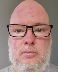 Bilden dagen efter bilden före.