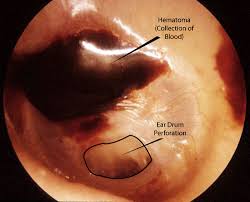 What are causes, signs and symptoms of ruptured eardrum. Ear Trauma Images Mcgovern Medical School