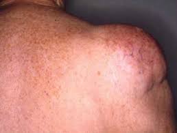 Check spelling or type a new query. Lipoma And Liposarcoma Dermnet Nz