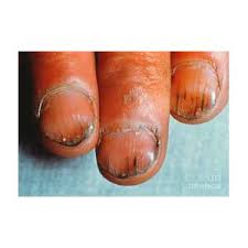 Image result for Koilonychia feet