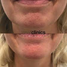Laser hair removal service in macquarie park, new south wales. North Ryde Macquarie Centre Laser Clinics Australia