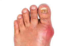 Image result for gout symptoms toe
