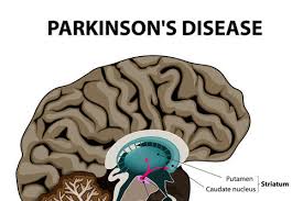 Here is our top pick. The Cause Of Parkinson S Disease Edison Home Health Care