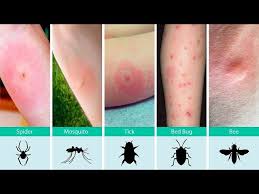 It may involve swelling and a fever. Is Mosquito Allergy Real Some React Severely To Those Annoying Bites And It S Called The Skeeter Syndrome