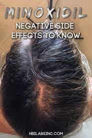 11 Negative Minoxidil Side Effects To Know Hair Loss Natural Remedy Natural Hair Regrowth Hair Loss Cure