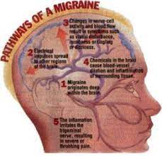 List Of Prescription Migraine Medicine Natural Headache Remedies Migraine Medication Headache Treatment