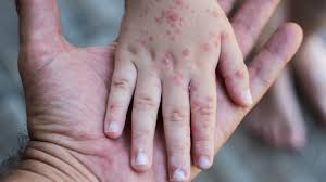 Image result for Rubella
