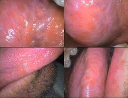 Image result for white cancer on tongue)