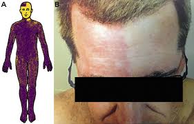 Image result for Anhidrosis