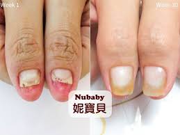 翹甲矯正挽救他店不當處理的飛甲 妮寶貝指甲 nails beauty