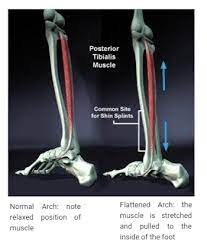 How To Treat Shin Splints | What It Is - Causes - Treatments