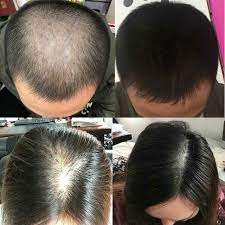 Research shows that, when used consistently for several months, minoxidil may help stop hair loss and may improve the thickness of existing hair. Best Hair Growth Products And Hair Loss Treatments