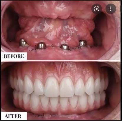 Dental implant product image