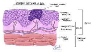 Image result for spinocellular carcinoma of the oral cavity