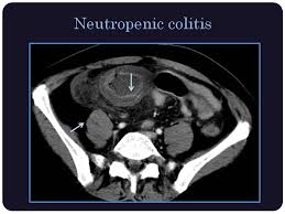 Image result for Neutropenic Colitis