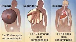 The signs and symptoms of syphilis vary depending in which of the four stages it presents (primary, secondary, latent, and tertiary). Pin On Seminario