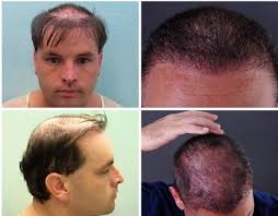 Although the cause of hair loss is easily diagnosed in some cas. Body Hair Transplant Photos And What Patients Should Know