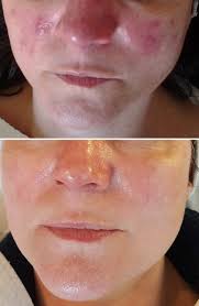 Rosacea Management in Bedford