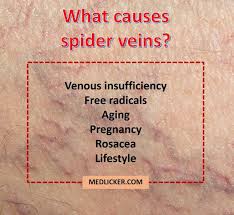 It is because these spider veins are quite visible and prominent on the soft skin of the face and it makes you look odd as well. Spider Veins Causes Symptoms Medical And Natural Treatments